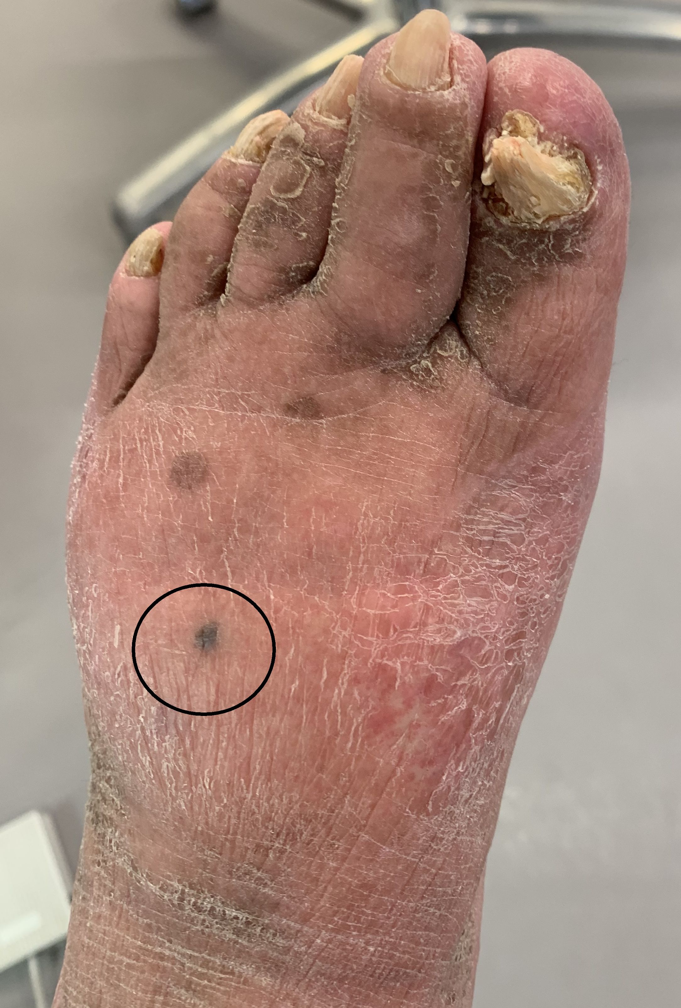 Melanoom